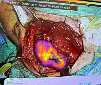 shot of inside of the body during surgery